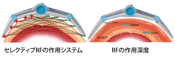 ヴァンキッシュによる脂肪溶解メカニズム