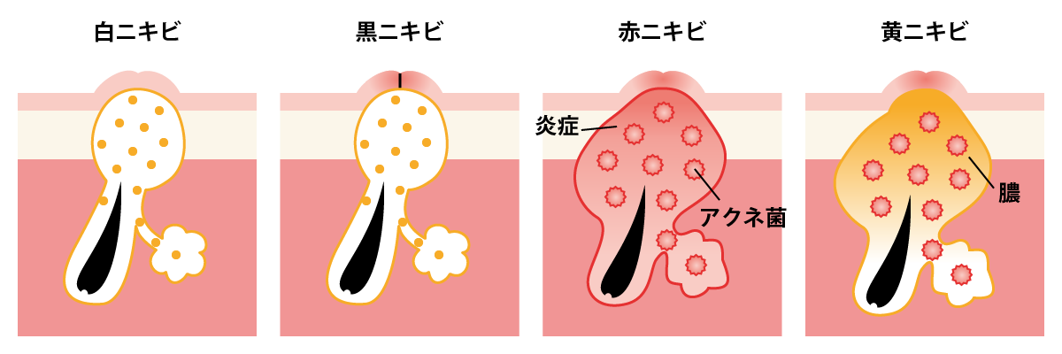 ニキビ