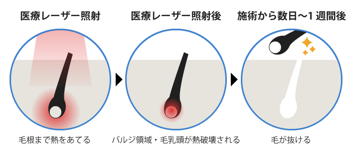 医療脱毛のしくみ